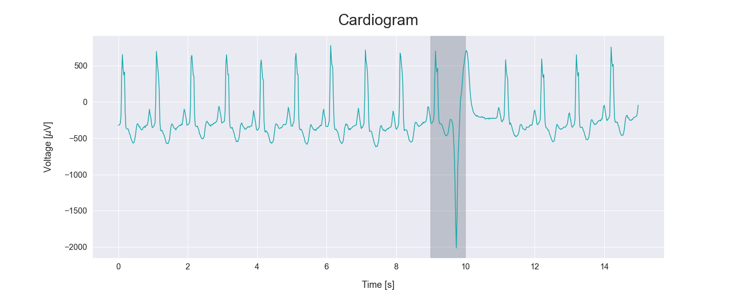 highlighted anomaly in cardiogram